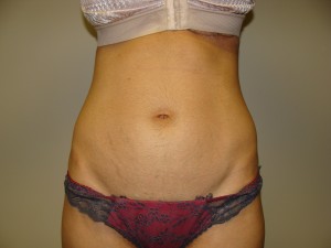 Liposuction Before and After | Grover Aesthetics