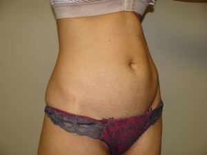 Liposuction Before and After 50 | Grover Aesthetics