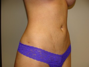 Liposuction Before and After 50 | Grover Aesthetics