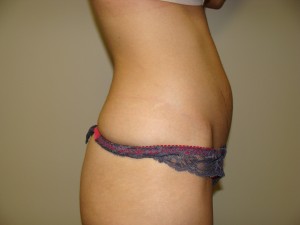 Liposuction Before and After 50 | Grover Aesthetics