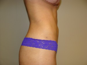 Liposuction Before and After 50 | Grover Aesthetics
