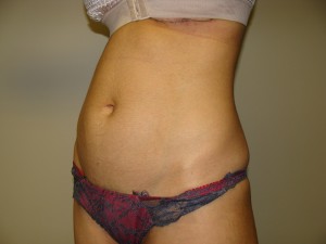 Liposuction Before and After 50 | Grover Aesthetics