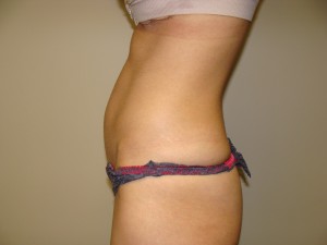 Liposuction Before and After 50 | Grover Aesthetics