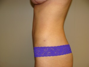 Liposuction Before and After 50 | Grover Aesthetics