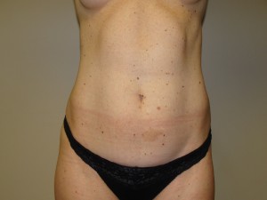 Liposuction Before and After | Grover Aesthetics