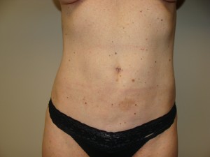 Liposuction Before and After | Grover Aesthetics