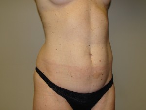 Liposuction Before and After 51 | Grover Aesthetics