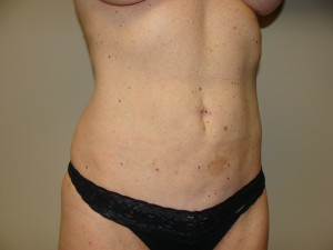 Liposuction Before and After 51 | Grover Aesthetics