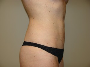 Liposuction Before and After 51 | Grover Aesthetics