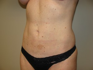 Liposuction Before and After 51 | Grover Aesthetics