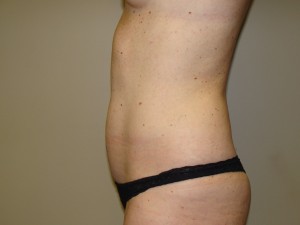 Liposuction Before and After 51 | Grover Aesthetics