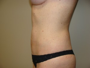 Liposuction Before and After 51 | Grover Aesthetics