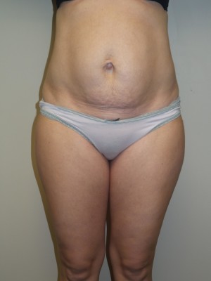 Liposuction Before and After 55 | Sanjay Grover MD FACS