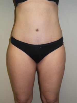 Liposuction Before and After | Grover Aesthetics
