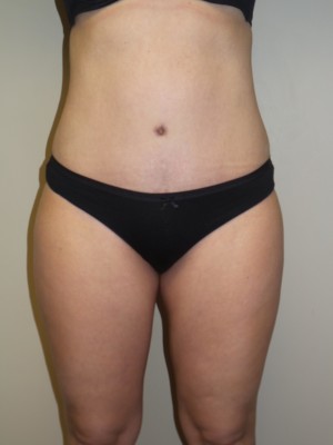 Liposuction Before and After 52 | Sanjay Grover MD FACS