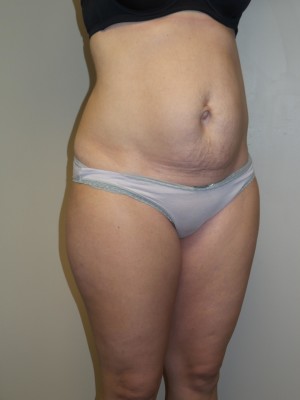 Liposuction Before and After 52 | Sanjay Grover MD FACS