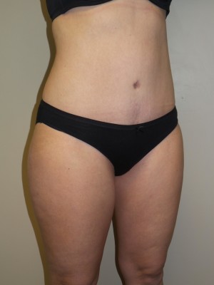 Liposuction Before and After 52 | Grover Aesthetics