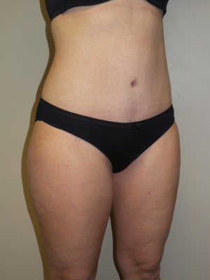 Liposuction Before and After 52 | Sanjay Grover MD FACS