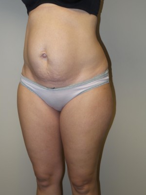 Liposuction Before and After 52 | Grover Aesthetics