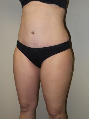 Liposuction Before and After 52 | Sanjay Grover MD FACS