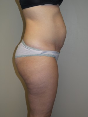 Liposuction Before and After 52 | Grover Aesthetics