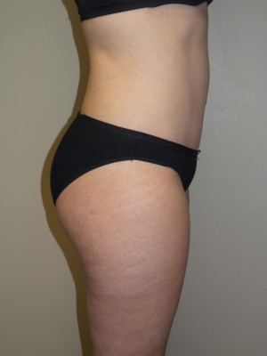 Liposuction Before and After 52 | Grover Aesthetics
