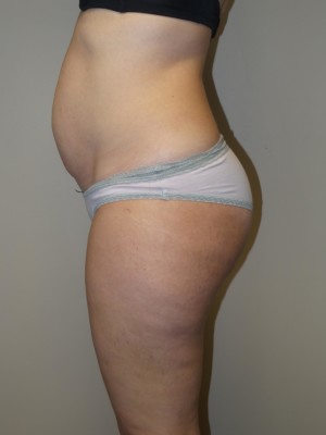 Liposuction Before and After 52 | Grover Aesthetics