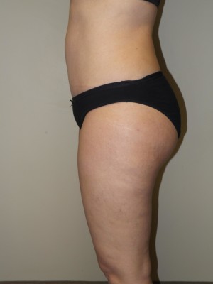 Liposuction Before and After 52 | Grover Aesthetics