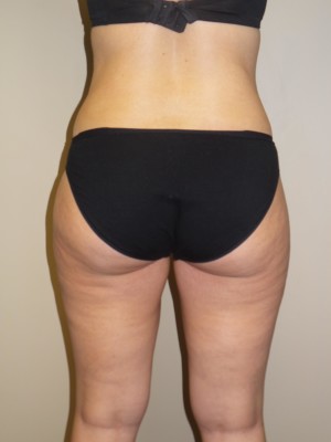 Liposuction Before and After 52 | Grover Aesthetics