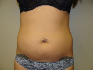 Liposuction Before and After | Grover Aesthetics