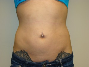 Liposuction Before and After | Grover Aesthetics