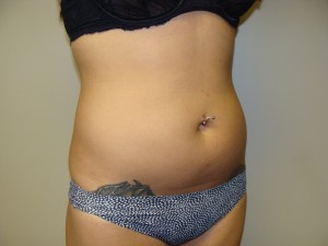 Liposuction Before and After 53 | Grover Aesthetics