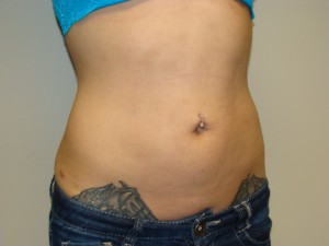Liposuction Before and After 53 | Grover Aesthetics