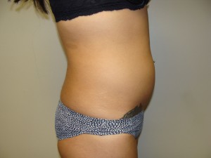 Liposuction Before and After 53 | Grover Aesthetics
