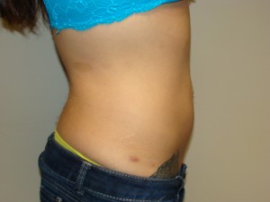 Liposuction Before and After 53 | Grover Aesthetics