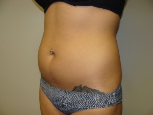 Liposuction Before and After 53 | Grover Aesthetics
