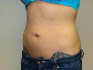 Liposuction Before and After 53 | Grover Aesthetics