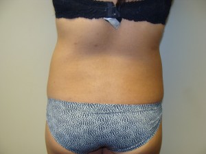 Liposuction Before and After 53 | Grover Aesthetics