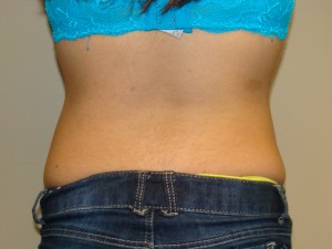 Liposuction Before and After 53 | Grover Aesthetics