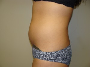 Liposuction Before and After 53 | Grover Aesthetics
