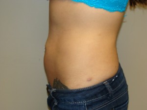 Liposuction Before and After 53 | Grover Aesthetics
