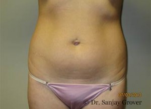 Liposuction Before and After 34 | Sanjay Grover MD FACS