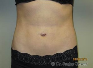 Liposuction Before and After | Sanjay Grover MD FACS