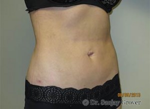 Liposuction Before and After 54 | Sanjay Grover MD FACS