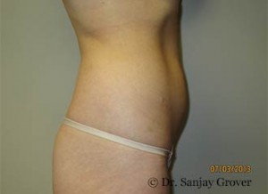 Liposuction Before and After 54 | Sanjay Grover MD FACS