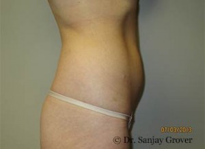 Liposuction Before and After 54 | Grover Aesthetics