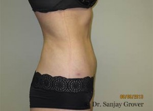 Liposuction Before and After 54 | Sanjay Grover MD FACS