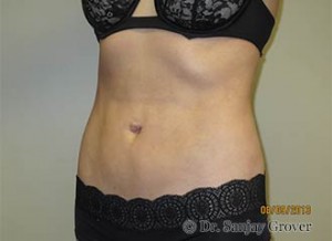 Liposuction Before and After 54 | Sanjay Grover MD FACS