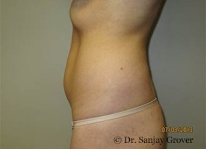 Liposuction Before and After 54 | Grover Aesthetics