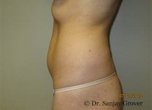 Liposuction Before and After 54 | Sanjay Grover MD FACS